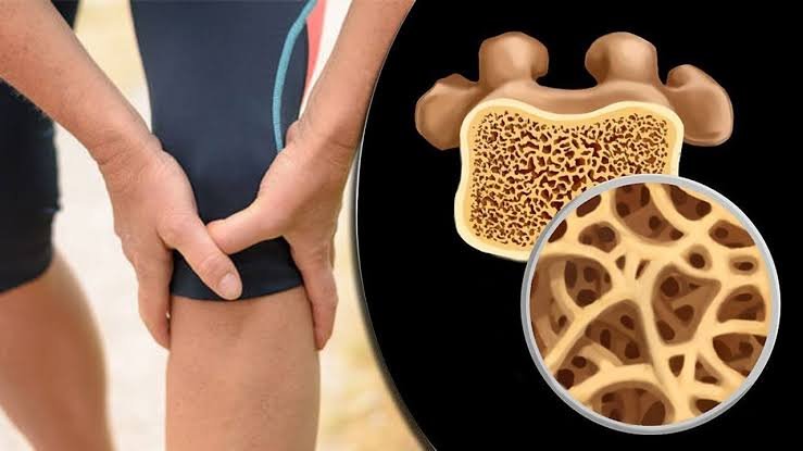 للوقاية من هشاشة العظام.. 4 أطعمة لها مفعول مذهل