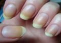 الأظافر الصفراء.. ما هي أسبابها وطرق العلاج