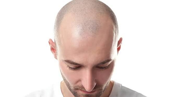 يصيب نصف الرجال.. طرق طبيعية لعلاج الصلع الذكوري