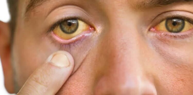 علامات الإصابة بالفشل الكبدي… كيف تكتشفها