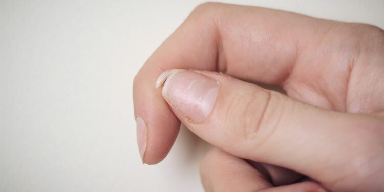 هل تعانين من أظافر ضعيفة؟.. إليك الحل النهائي