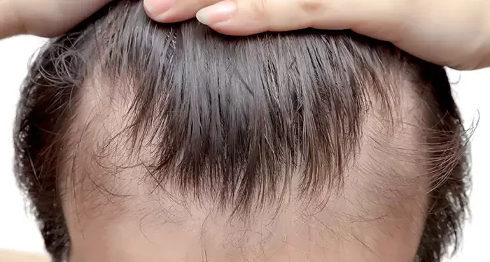 حل بسيط لعلاج الصلع الوراثي!