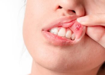 ودعي قرح الفم في دقائق.. حلول طبيعية مضمونة