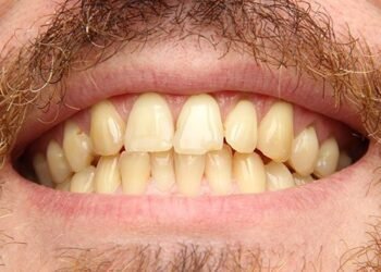 هل لاحظت تغيرًا في لون الأسنان؟.. احذر قد تكون مصابًا بمرض خطير