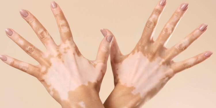 لمرضى البهاق.. أمل جديد في علاج يحقق نتائج مبهرة