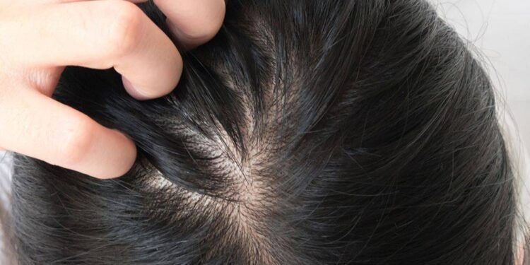 حل سحري من مطبخك يقضي على الصلع ويمنع تساقط الشعر!