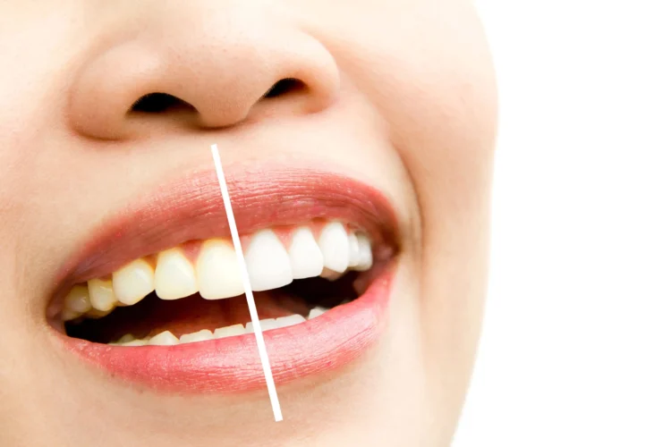 عادات خاطئة تسبب اصفرار الأسنان وكيف تحصل على ابتسامة ناصعة البياض