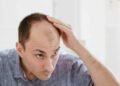 وصفات تقضي على الصلع للرجال وتستعيد كثافة الشعر