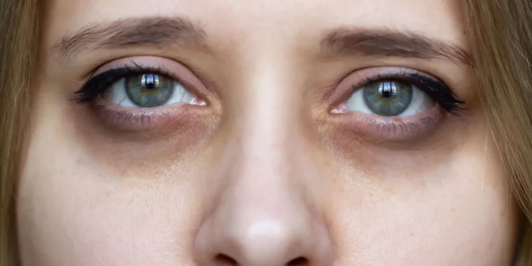 الهالات السوداء.. 5 إنذارات صحية تختبئ وراءها!