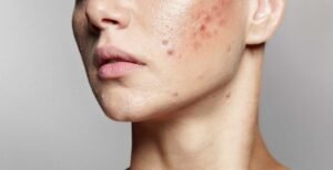 Acne Update 1600x821 1