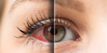 Dry eye before and after 2 1