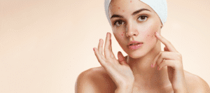 acne girl foreo