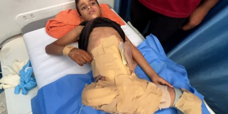 مأساة طفل من غزة.. “سند” يعيش بـ نصف جسد