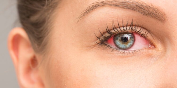 احمرار العينين.. إليك العلاج والوقاية