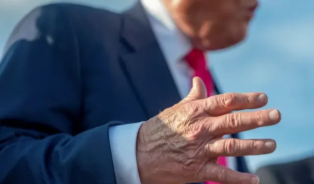 مرض ترامب الجديد.. أعراض القصور الوريدي المزمن