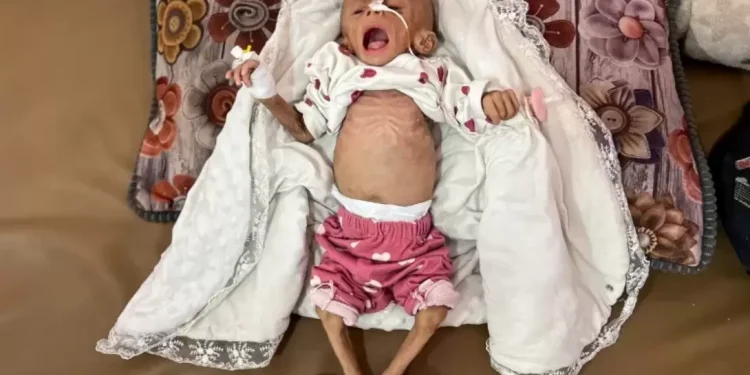 مجاعة ممنهجة.. أكثر من 40 ألف رضيع في غزة يواجهون الموت