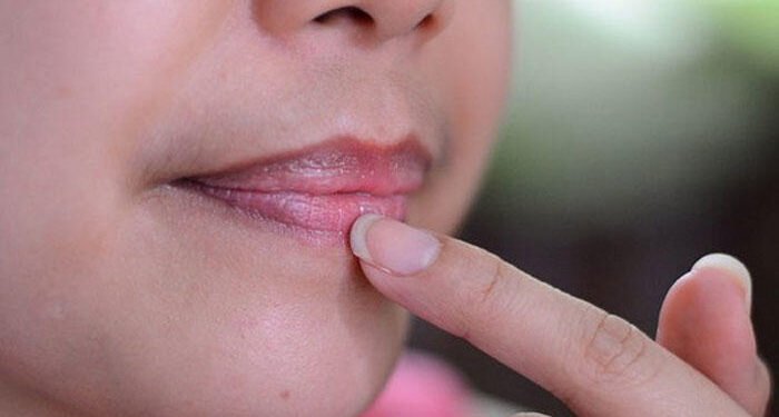 السواد حول الفم.. حلول فعالة لعلاج التصبغ