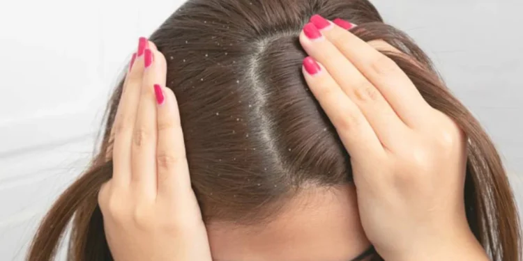 قشرة الشعر.. طريقة سحرية للتخلص منها