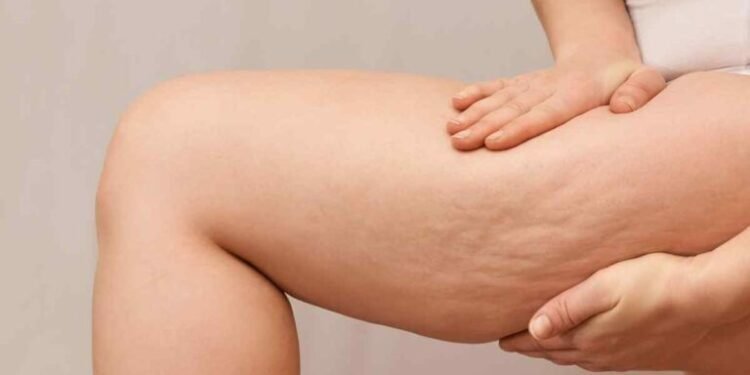 أفضل كريمات علاج السيلوليت وشد الجلد