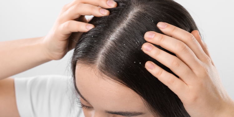 طرق التخلص من قشرة الشعر نهائيا.. 5 وصفات طبيعية