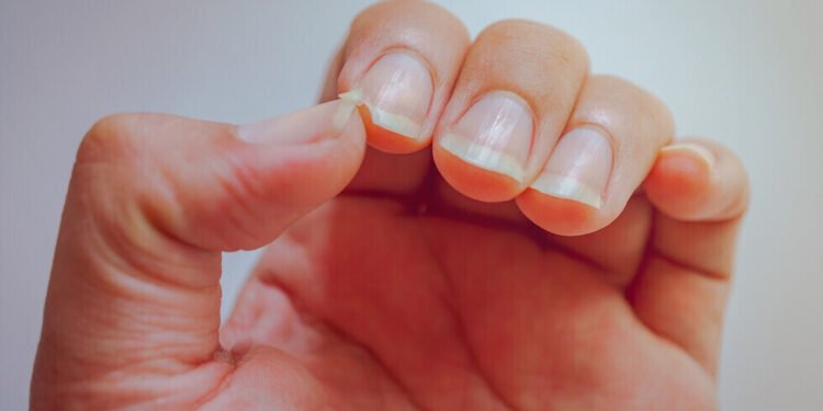 علامات في الأظافر تشير إلى إصابتك بهذه الأمراض