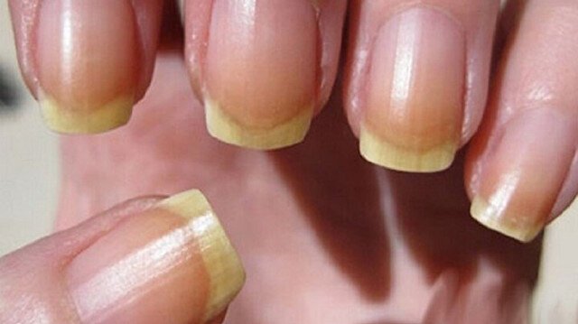 الأظافر الشاحبة والمقعّرة