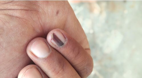 علامات في الأظافر تشير إلى هذه الأمراض