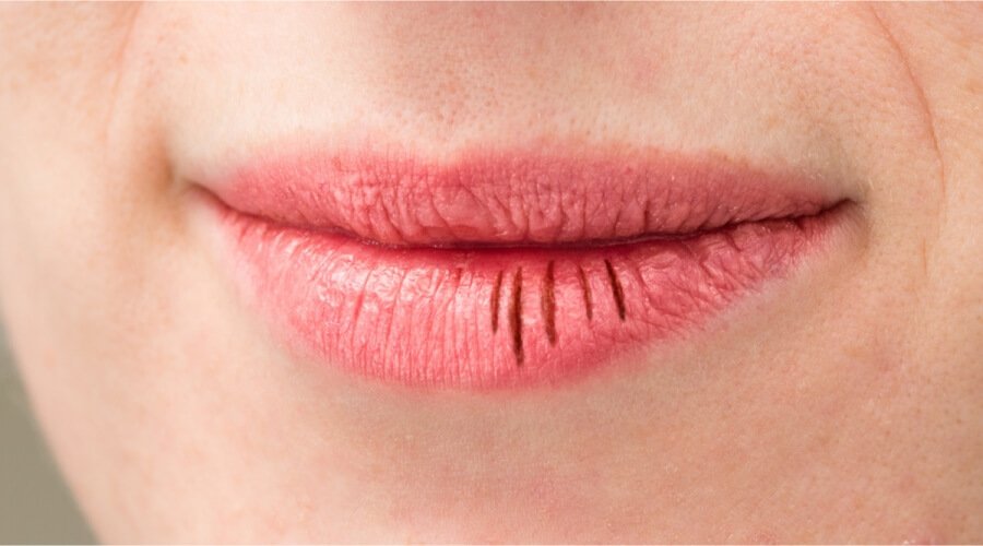 علاج تشقق الشفاه.. وداعاً للنزيف والآلام