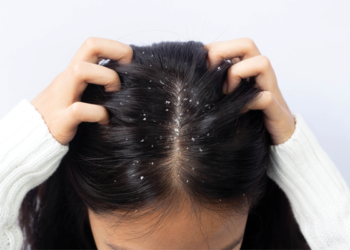 علاج القشرة.. وصفات طبيعية منزلية تقضي عليها