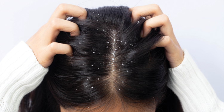 علاج القشرة.. وصفات طبيعية منزلية تقضي عليها