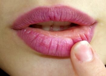 علاج تشقق الشفاه بوصفات طبيعية من مطبخك