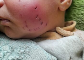 الرضيع آدم يدق ناقوس الخطر.. كارثة تحاصر خيام النازحين بغزة