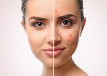 لصقات حب الشباب.. علاج البثور بسرعة وفعالية في المنزل