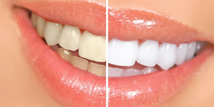 طرق تبييض الأسنان في المنزل بخطوات بسيطة