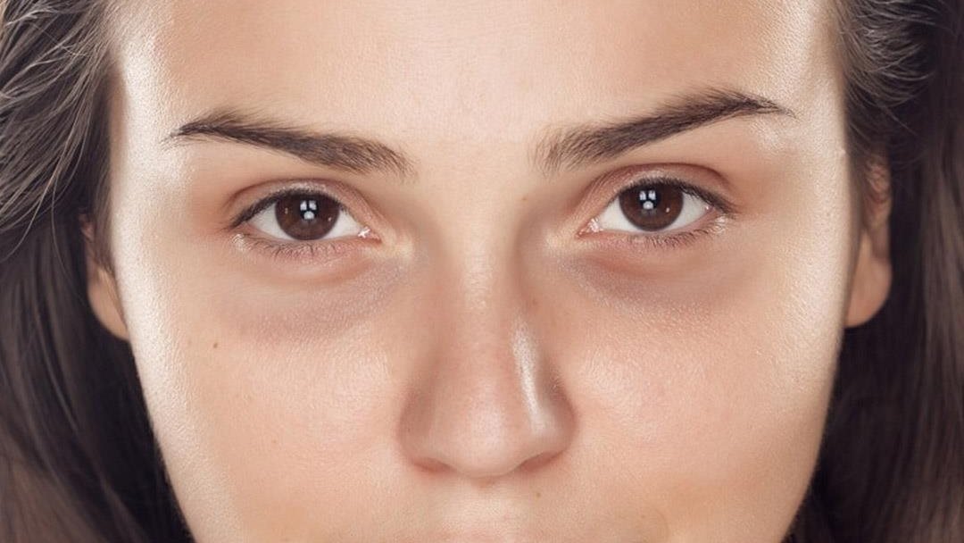 الهالات السوداء.. أسباب خفية وراء سواد تحت العين وطرق علاجها