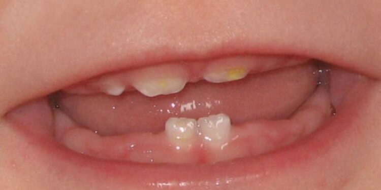 كيفية حماية أسنان الرضع من التسوس