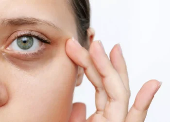 الهالات السوداء.. أسباب خفية وراء سواد تحت العين وطرق علاجها