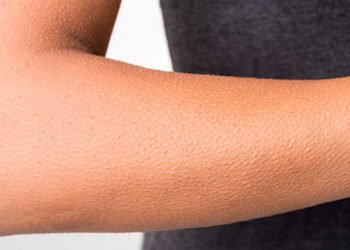 لبشرة حريرية.. دليلك للتخلص من جلد الوزة