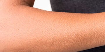 لبشرة حريرية.. دليلك للتخلص من جلد الوزة