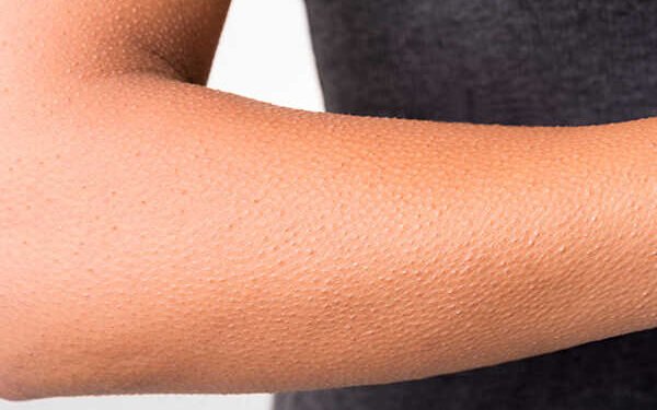 لبشرة حريرية.. دليلك للتخلص من جلد الوزة