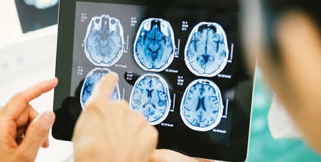 أورام الدماغ.. دليل شامل لفهم عوامل الخطر وطرق الوقاية