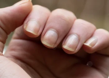 وصفات منزلية ساحرة للتخلص من اصفرار الأظافر وتبييضها طبيعيا